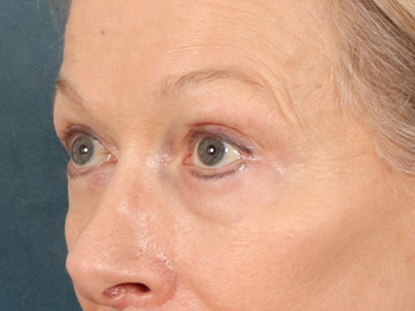 Eyelid Lift Before & After Gallery - Patient 319200 - Image 8