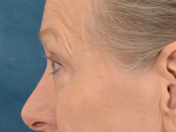 Eyelid Lift Before & After Gallery - Patient 319200 - Image 9