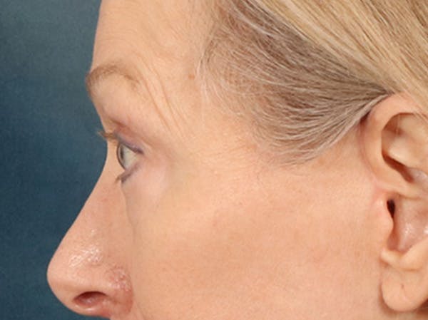 Eyelid Lift Before & After Gallery - Patient 319200 - Image 10