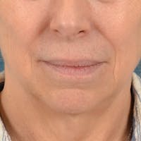 Lip Lift Before & After Gallery - Patient 268199 - Image 1
