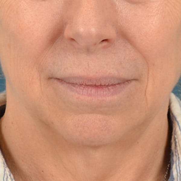 Lip Lift Before & After Gallery - Patient 268199 - Image 1