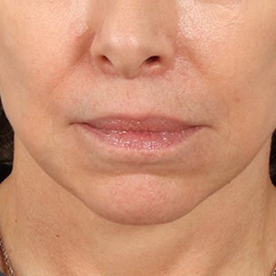 Lip Lift Before & After Gallery - Patient 268199 - Image 2