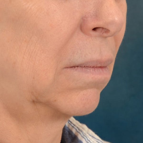 Lip Lift Before & After Gallery - Patient 268199 - Image 3