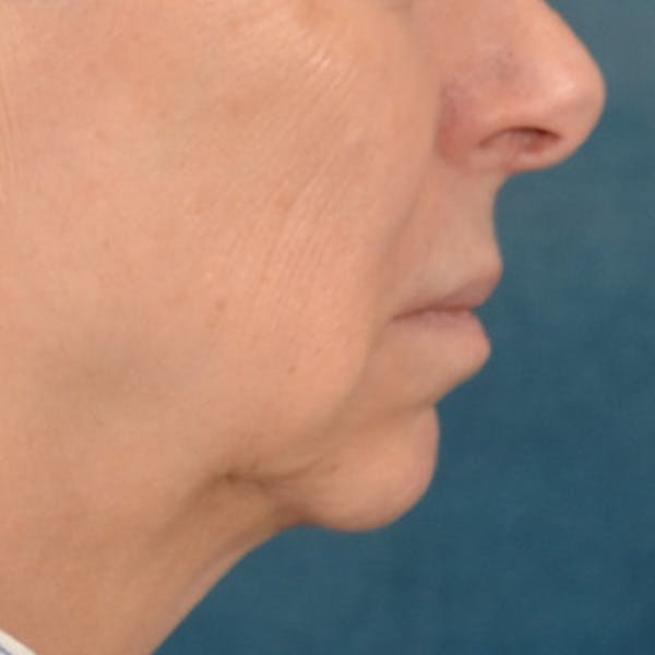 Lip Lift Before & After Gallery - Patient 268199 - Image 5