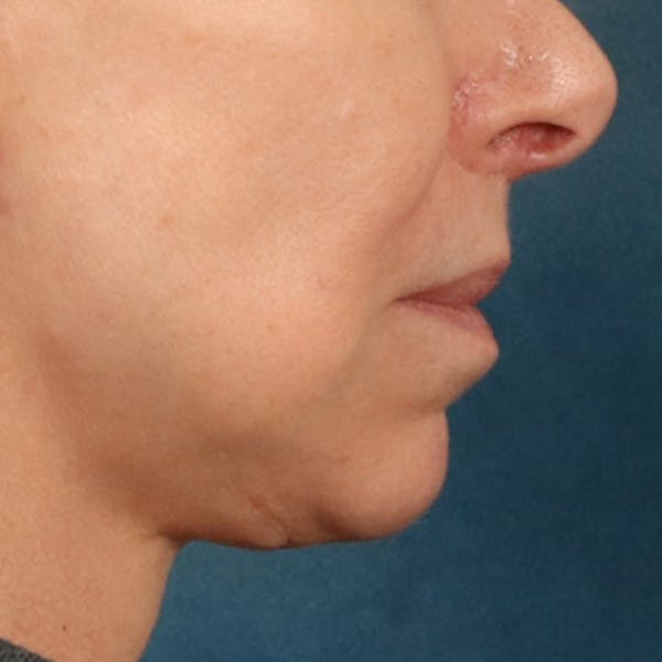 Lip Lift Before & After Gallery - Patient 268199 - Image 6