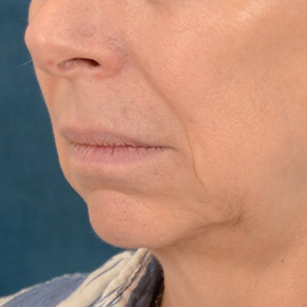Lip Lift Before & After Gallery - Patient 268199 - Image 7