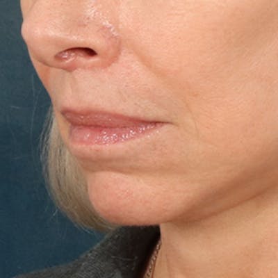 Lip Lift Before & After Gallery - Patient 268199 - Image 8