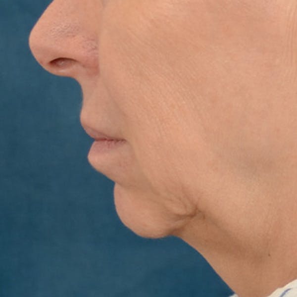 Lip Lift Before & After Gallery - Patient 268199 - Image 9