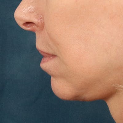 Lip Lift Before & After Gallery - Patient 268199 - Image 10