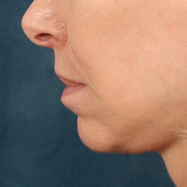 Lip Lift Before & After Gallery - Patient 268199 - Image 10
