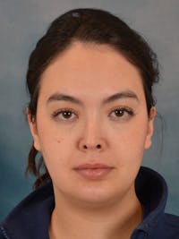 Deep Neck Lift Before & After Gallery - Patient 247096 - Image 1