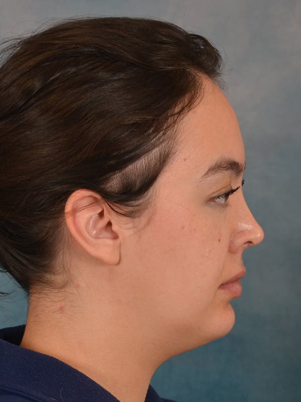 Laser Skin Resurfacing Before & After Gallery - Patient 279068 - Image 5