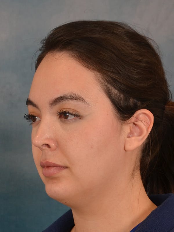 Laser Skin Resurfacing Before & After Gallery - Patient 279068 - Image 7