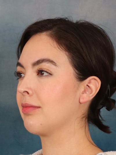 Laser Skin Resurfacing Before & After Gallery - Patient 279068 - Image 8