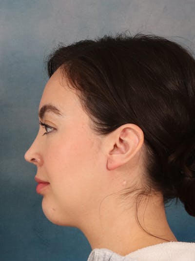 Laser Skin Resurfacing Before & After Gallery - Patient 279068 - Image 10