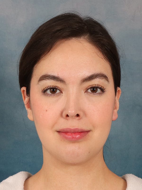 Laser Skin Resurfacing Before & After Gallery - Patient 279068 - Image 2