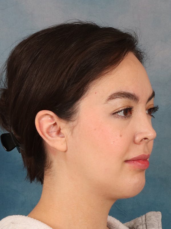 Laser Skin Resurfacing Before & After Gallery - Patient 279068 - Image 4