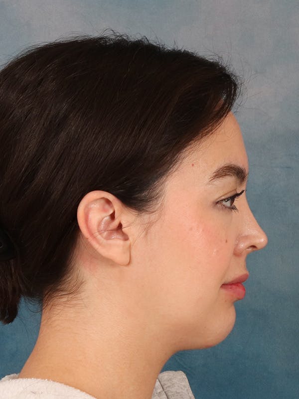 Laser Skin Resurfacing Before & After Gallery - Patient 279068 - Image 6