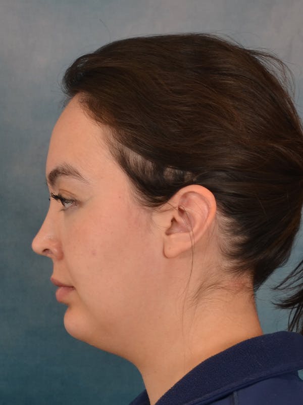 Laser Skin Resurfacing Before & After Gallery - Patient 279068 - Image 9