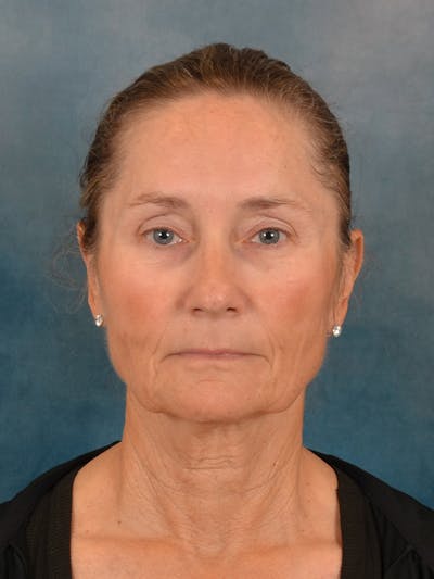 Laser Skin Resurfacing Before & After Gallery - Patient 686052 - Image 1