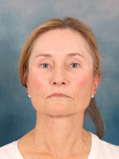 Laser Skin Resurfacing Before & After Gallery - Patient 686052 - Image 2