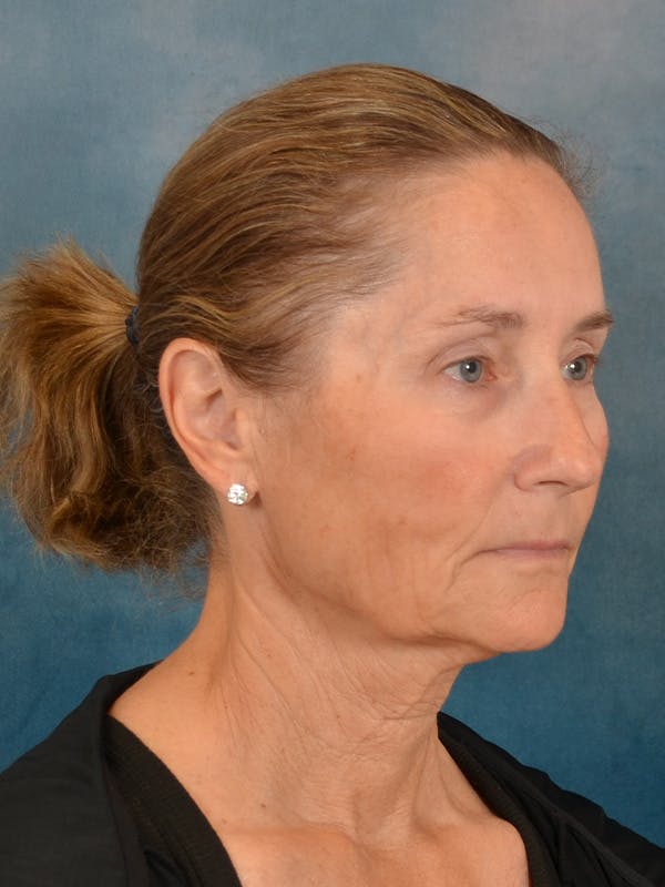 Laser Skin Resurfacing Before & After Gallery - Patient 686052 - Image 3