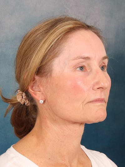 Laser Skin Resurfacing Before & After Gallery - Patient 686052 - Image 4