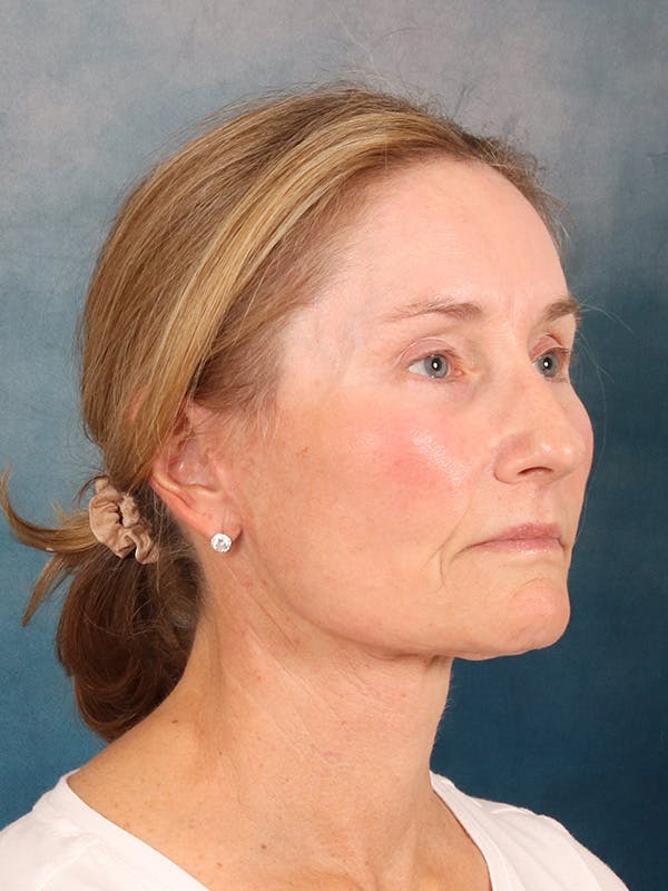Laser Skin Resurfacing Before & After Gallery - Patient 686052 - Image 4