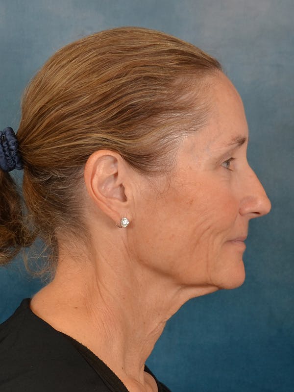 Laser Skin Resurfacing Before & After Gallery - Patient 686052 - Image 5