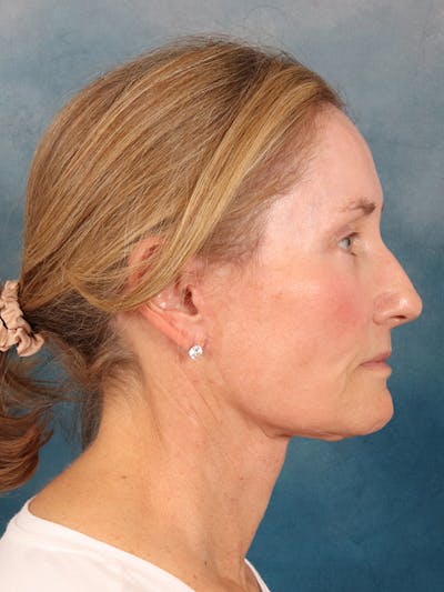 Laser Skin Resurfacing Before & After Gallery - Patient 686052 - Image 6