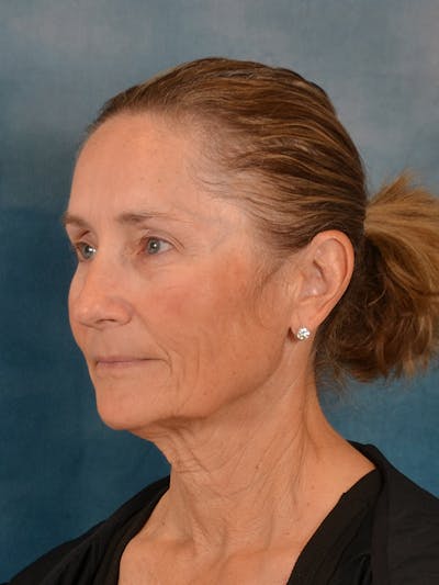 Deep Plane Facelift Before & After Gallery - Patient 207504 - Image 1