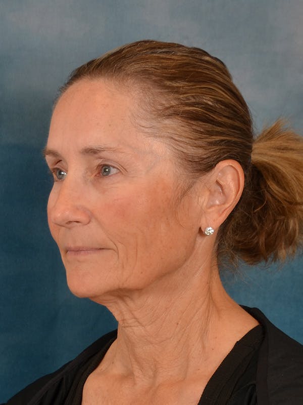 Laser Skin Resurfacing Before & After Gallery - Patient 686052 - Image 7