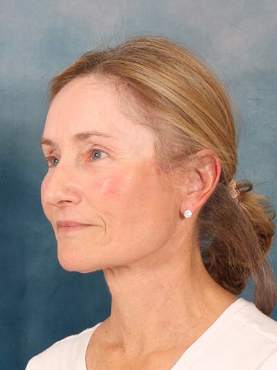 Laser Skin Resurfacing Before & After Gallery - Patient 686052 - Image 8