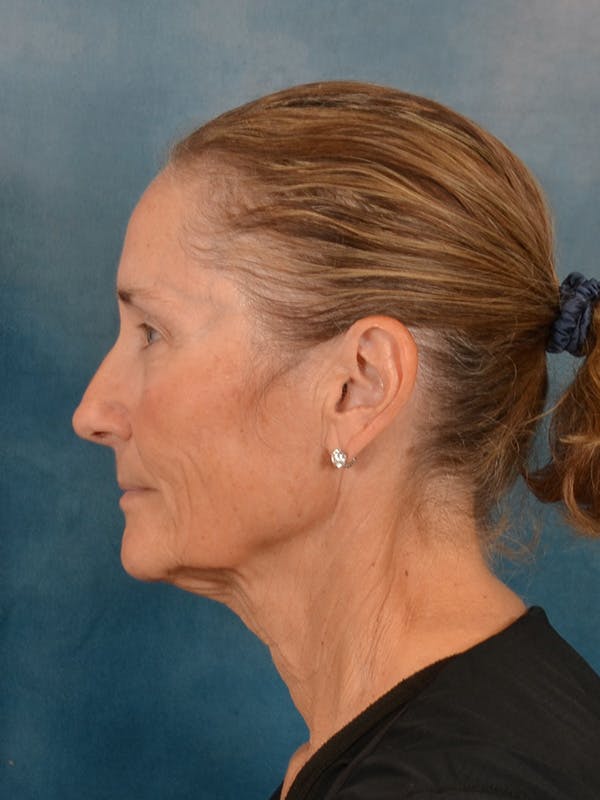 Laser Skin Resurfacing Before & After Gallery - Patient 686052 - Image 9