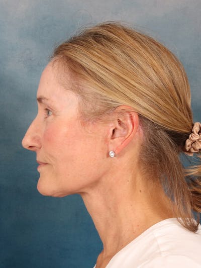 Laser Skin Resurfacing Before & After Gallery - Patient 686052 - Image 10