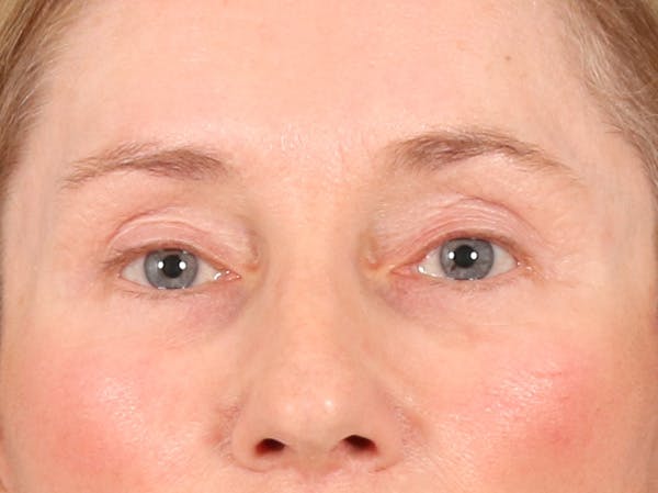 Eyelid Lift Before & After Gallery - Patient 398793 - Image 2