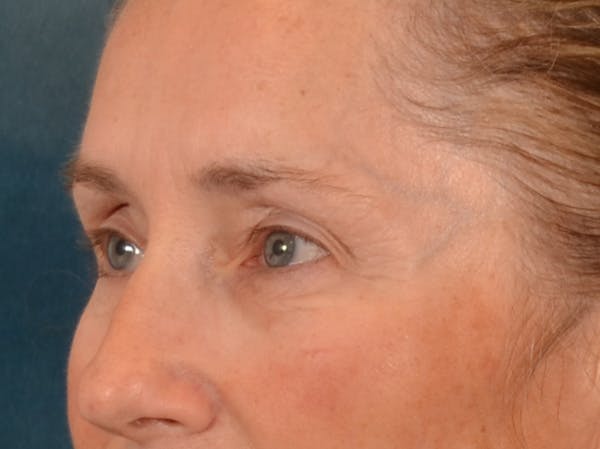Eyelid Lift Before & After Gallery - Patient 398793 - Image 7