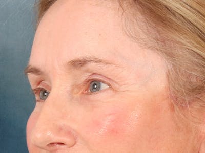 Eyelid Lift Before & After Gallery - Patient 398793 - Image 8