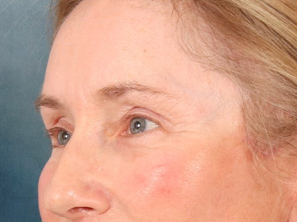 Eyelid Lift Before & After Gallery - Patient 398793 - Image 8