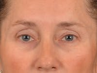 Eyelid Lift Before & After Gallery - Patient 398793 - Image 1