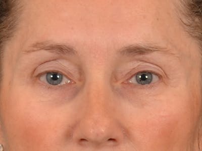 Eyelid Lift Before & After Gallery - Patient 398793 - Image 1