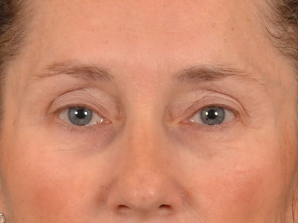 Eyelid Lift Before & After Gallery - Patient 398793 - Image 1
