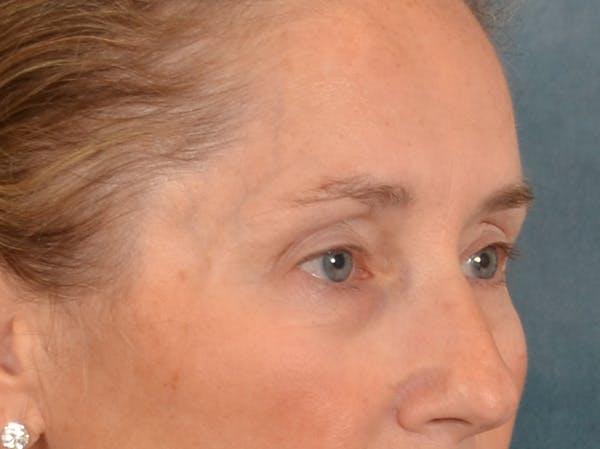 Eyelid Lift Before & After Gallery - Patient 398793 - Image 3