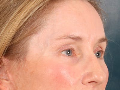 Eyelid Lift Before & After Gallery - Patient 398793 - Image 4