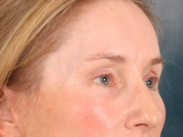 Eyelid Lift Before & After Gallery - Patient 398793 - Image 4