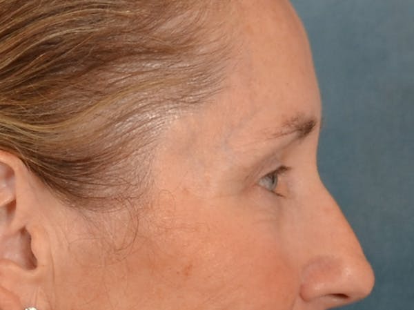 Eyelid Lift Before & After Gallery - Patient 398793 - Image 5