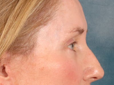 Eyelid Lift Before & After Gallery - Patient 398793 - Image 6