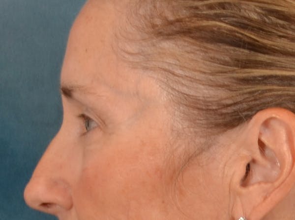 Eyelid Lift Before & After Gallery - Patient 398793 - Image 9