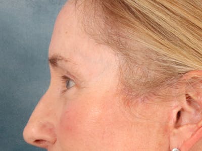 Eyelid Lift Before & After Gallery - Patient 398793 - Image 10