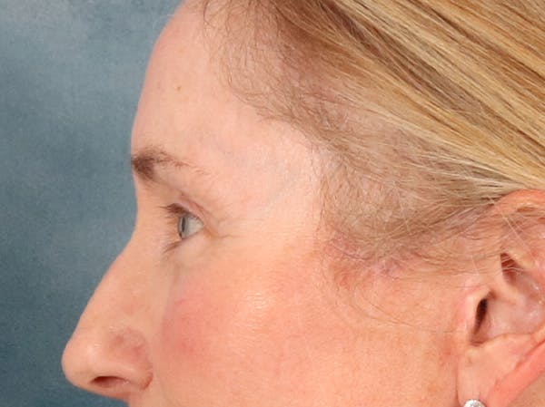 Eyelid Lift Before & After Gallery - Patient 398793 - Image 10